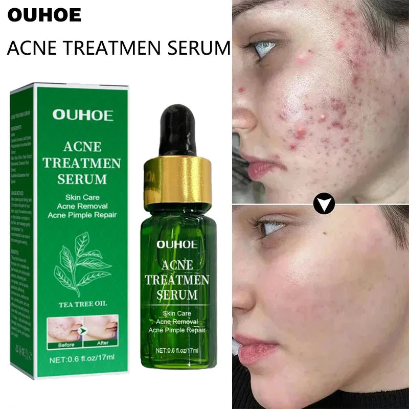 Acne Treatment Facial Serum Pore Shrinking Skin Care - Nurture By Nala