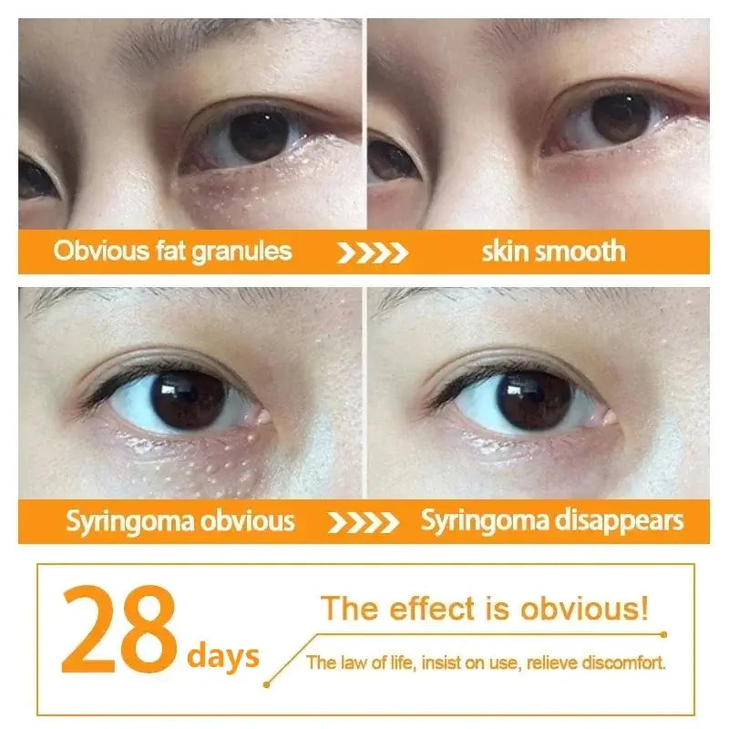 Before and after results showing the removal of fat granules and syringoma around eyes with LAIKOU Fat Granules Remover Eye Cream after 28 days