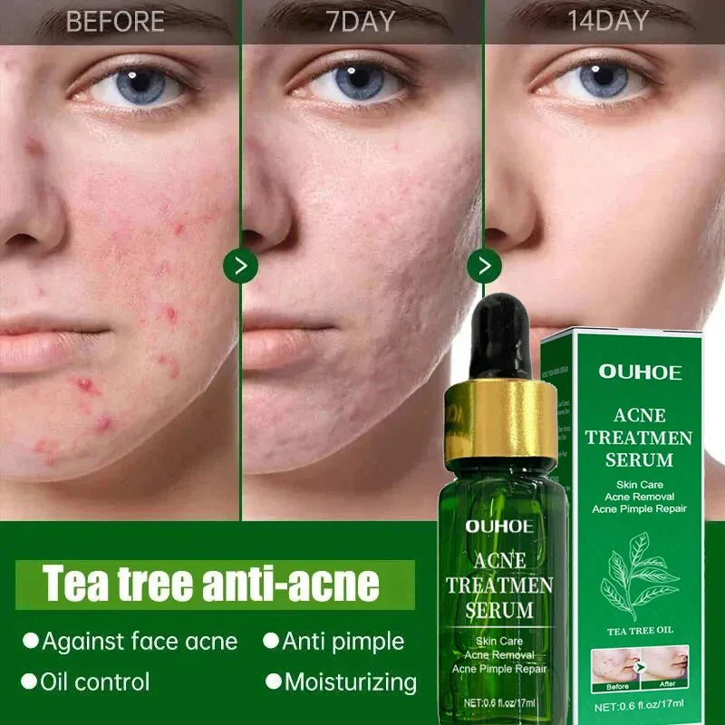 Acne Treatment Facial Serum Pore Shrinking Skin Care - Nurture By Nala